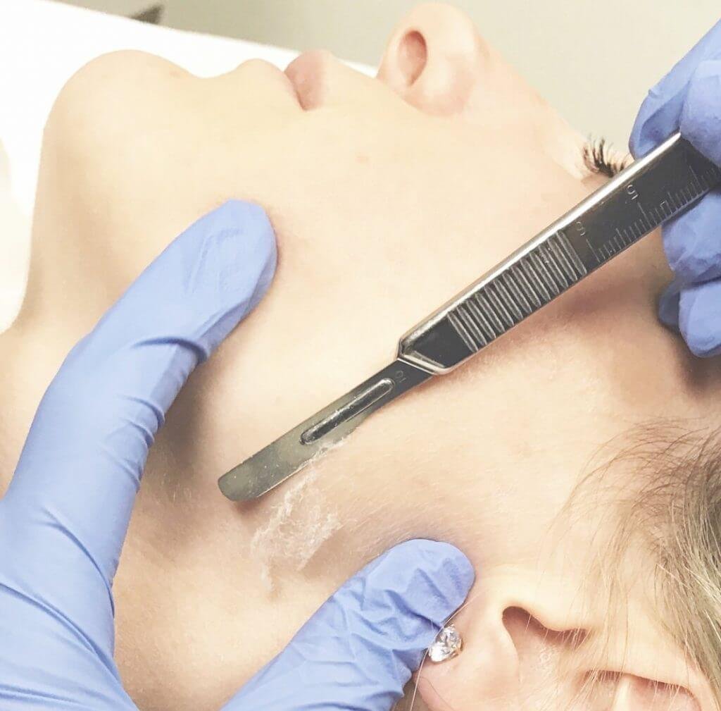 Dermaplaning