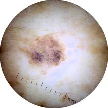 dermatoscope de 400